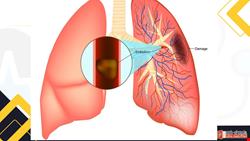 دانلود پاورپوینت پرستاری درمورد آمبولی ریه Pulmonary Embolism (PE)